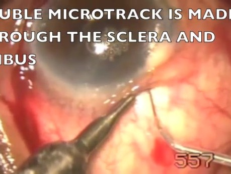 Complicated PCIOL- microtrack filtration