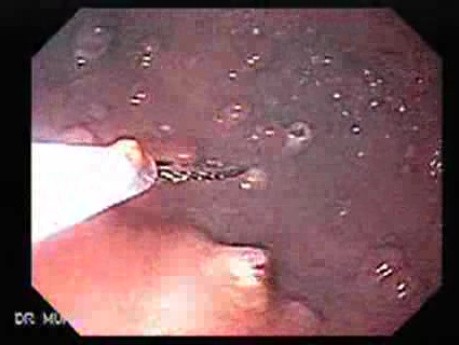 Gastric Polyposis - Endoscopy (10 of 11)