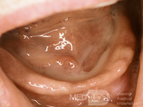 Suppurative Sialadenitis