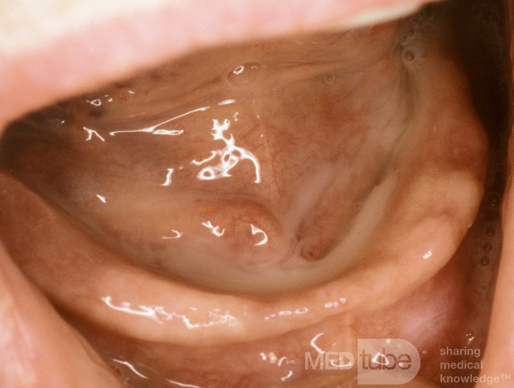 Suppurative Sialadenitis