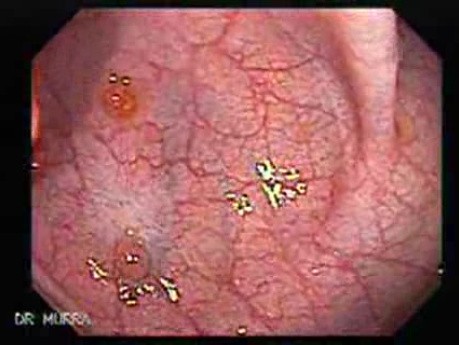 Non Familial Juvenile Polyposis Of The Colon (16 of 37)