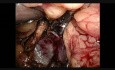 Retroperitoneoscopic Right Adrenalectomy
