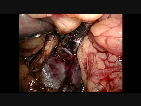 Retroperitoneoscopic Right Adrenalectomy