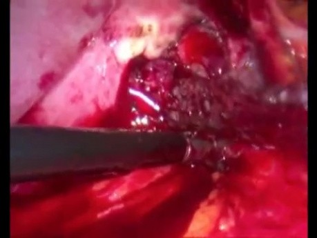 Transgastric Stent Removal - Laparoscopy