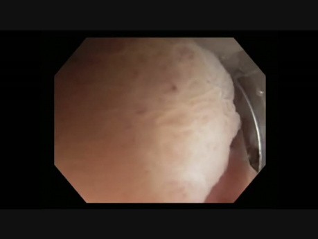 Colonoscopy - Rectosigmoid Colon Underwater EMR