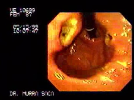 Multiple Gastric Ulcers (1 of 2)