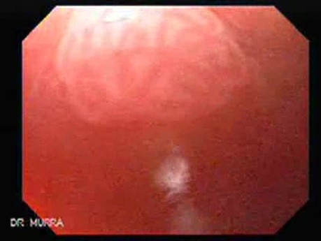 Flat Adenoma - Endoscopy (2 of 2)