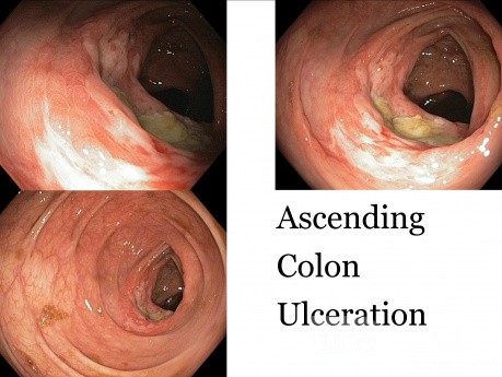 Ascending Colon Ulceration