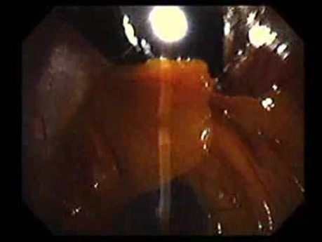 Gastrointestinal Stromal Tumor - GIST (39 of 65)