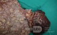 Mixed Mullerian Tumour Of The Uterus, 2