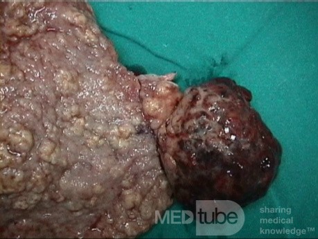 Mixed Mullerian Tumour Of The Uterus, 2