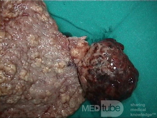 Mixed Mullerian Tumour Of The Uterus, 2