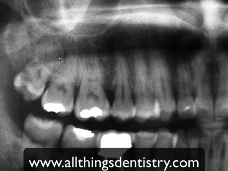 3Rd Molar Extractions - Maxillary Molar Apices