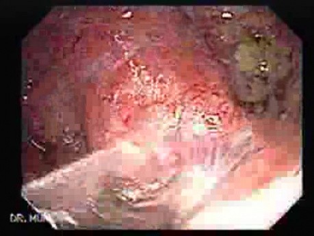 Severe case of Ischemic Colitis (9 of 19)
