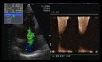 Arrhythmogenic Right Ventricular Cardiomyopathy ARVC or ARVD. A Case. ECG and Echocardiography
