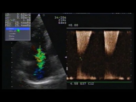 Arrhythmogenic Right Ventricular Cardiomyopathy ARVC or ARVD. A Case. ECG and Echocardiography