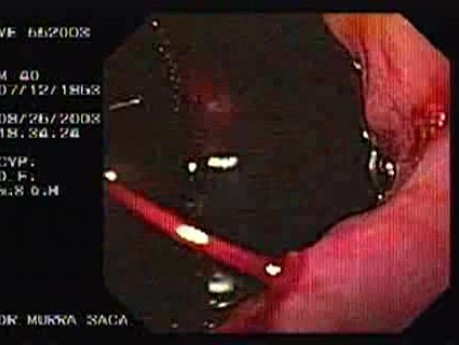 Acute Variceal Bleeding - Source of Bleeding, Part 1