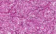 Renal cell carcinoma (hypernephroma) - Histopathology - Kidney