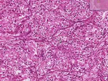 Renal cell carcinoma (hypernephroma) - Histopathology - Kidney