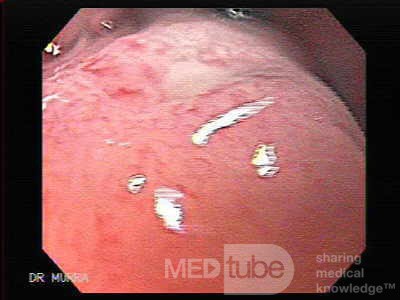 Large Gastric Varices (4 of 4)