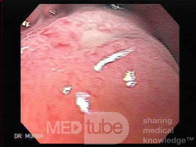 Large Gastric Varices (4 of 4)