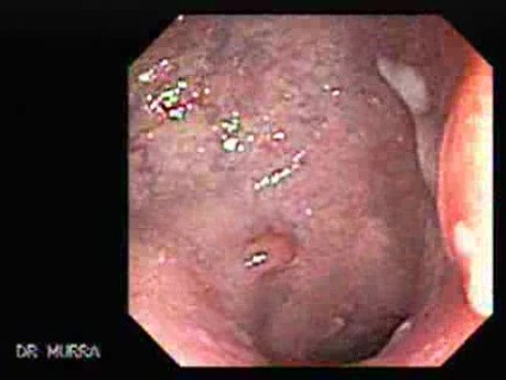 Cap Polyposis