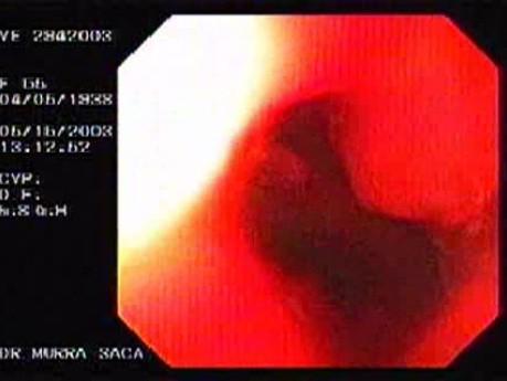 Banding of Esophageal Varices - Strangulated Varix, Part 2