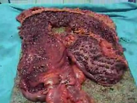 Multiple Rectal Ulcers (69 of 110)