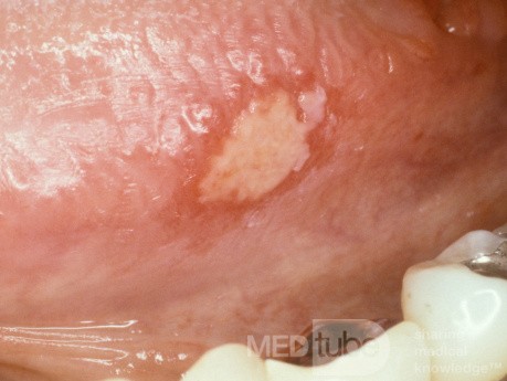Apthous Ulcer