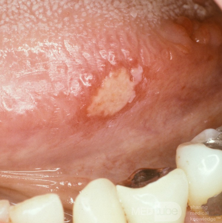 Apthous Ulcer