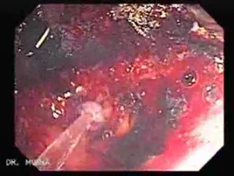 Endoscopic Resection of Giant Tubulo-Villous of the rectum (35 of 35)