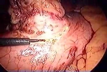Laparoscopic wide excision of GIST