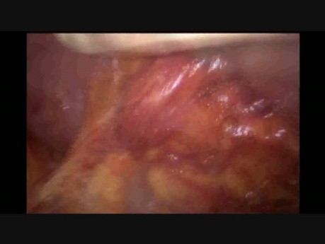 Minimally Invasive Donor Nephrectomy For Transplantation – Review Of Surgical Management