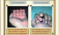 Common Hand Injuries: Part-2