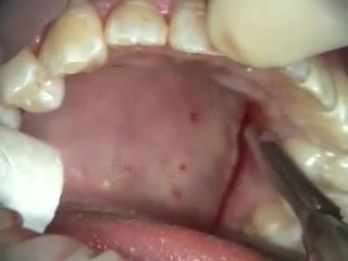 Connective Tissue Grafting