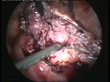 Removal of Heterotrophic Abdominal Pregnancy by Laparoscopic Technique