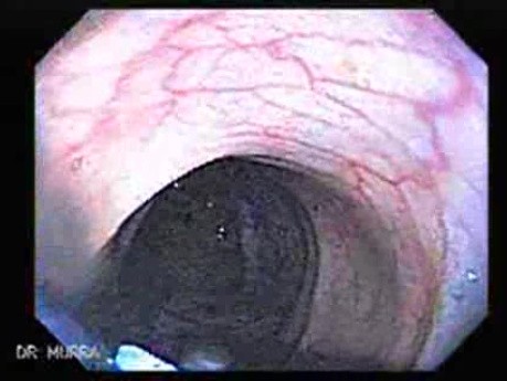 Juvenile Non Familial Polyposis of the Colon (30 of 37)