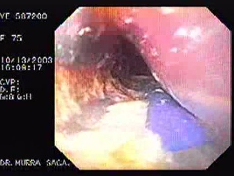 Treatment for Achalasia - Guide Wire and the Distal Tip of the Balloon Catheter in the Cardias