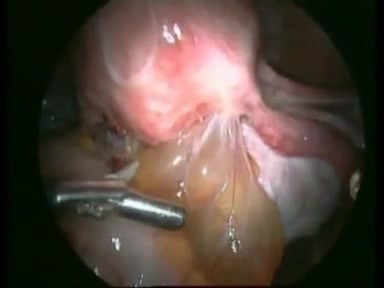 Excision of Rectovaginal Endometriotic Nodule by Laparoscopic Technique