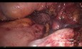 Redo Surgery for Recurrent Prolaps