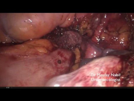 Redo Surgery for Recurrent Prolaps