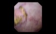  Description of Calcified Bladder Tumor