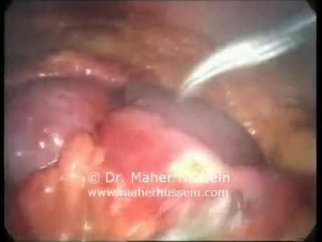 Post Gastric Bypass Complications - Laparoscopic Treatment
