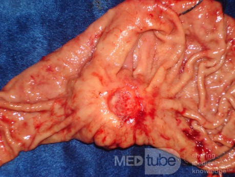 Diffuse Adenocarcinoma with signet ring cells (14 of 18)