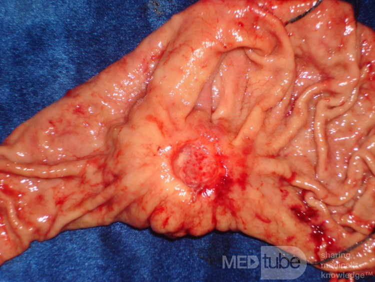 Diffuse Adenocarcinoma with signet ring cells (14 of 18)