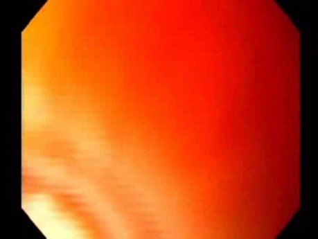 Endoscopic Balloon Removal (5 of 9)