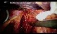 Robotic Laparoscopic Transhiatal Esophagectomy