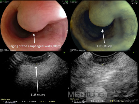 Esophagel leiomyoma of the "mucularis mucosae"
