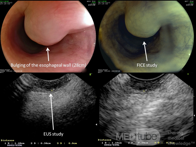 Esophagel leiomyoma of the "mucularis mucosae"