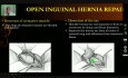 Open Inguinal Hernia Repair - Operative Surgery
